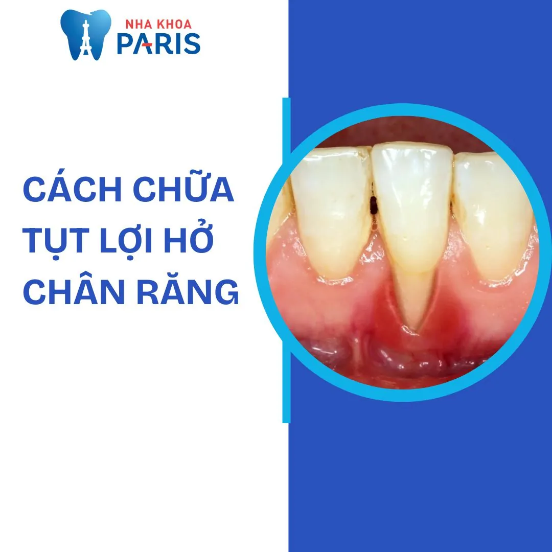 TOP 10 cách chữa tụt lợi hở chân răng dứt điểm, an toàn 