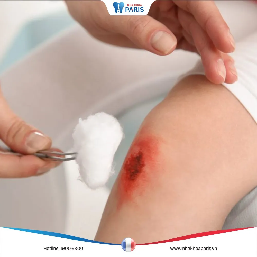 May vết thương hở nên kiêng ăn gì? Bí quyết từ chuyên gia