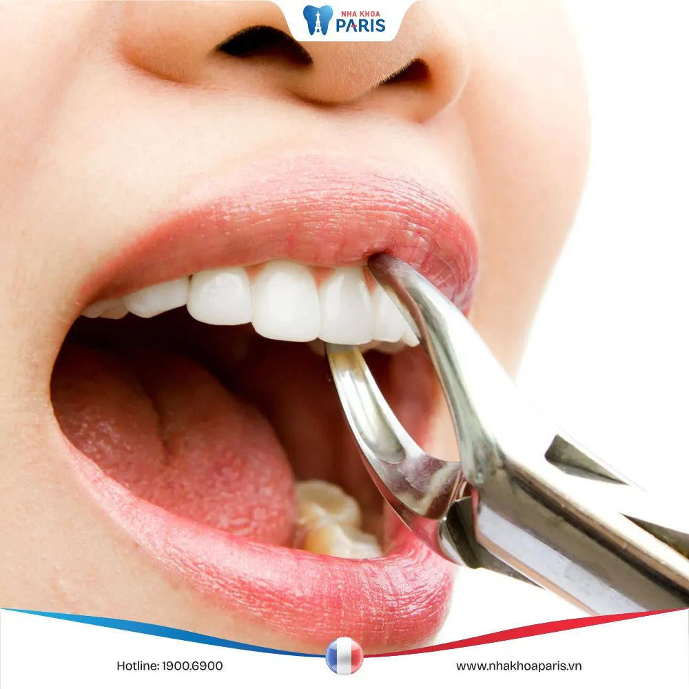 Nhổ răng cửa bao nhiêu tiền, Những lưu ý quan trọng khi thực hiện