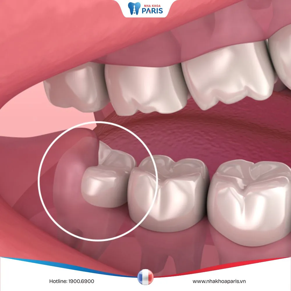 Lời giải cho thắc mắc: Nhổ răng khôn bao lâu thì lành?
