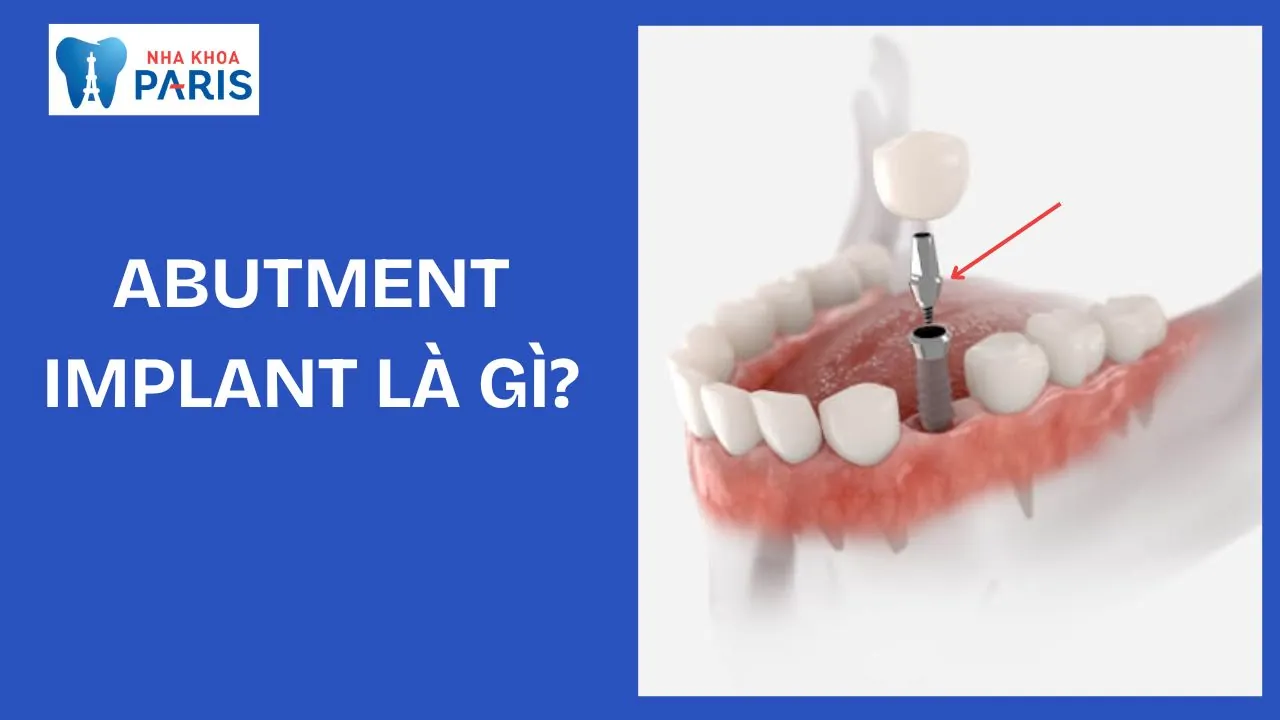 Abutment Implant là gì? Các loại khớp nối và quy trình thực hiện tại Nha Khoa Paris