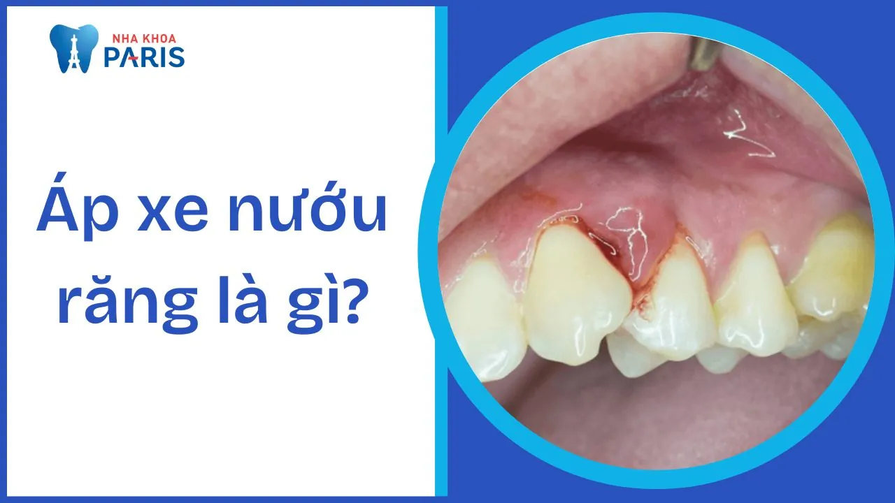 Áp xe nướu răng là gì? Nguyên nhân, triệu chứng và giải pháp hiệu quả