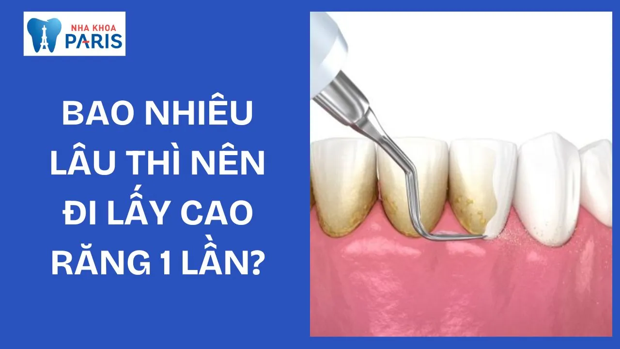 Bao nhiêu lâu thì nên đi lấy cao răng 1 lần? Dấu hiệu và phương pháp cần biết