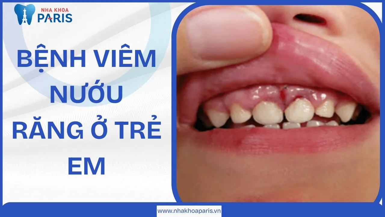Bệnh viêm nướu răng ở trẻ em: Nguyên nhân, dấu hiệu, cách điều trị