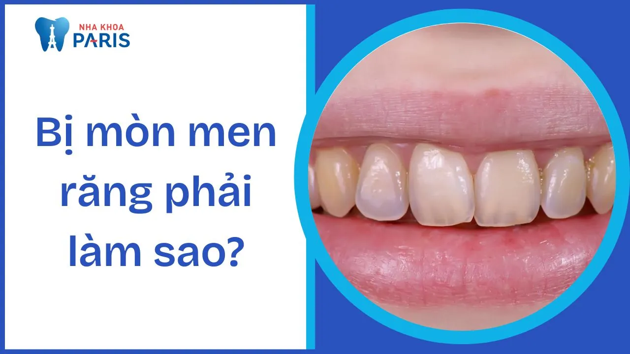 Bị mòn men răng phải làm sao? 9 cách khắc phục hiệu quả