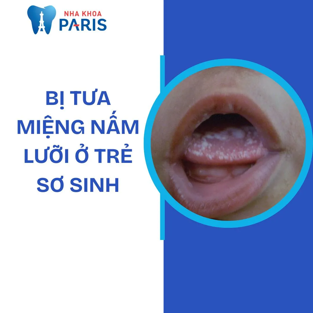 Bị tưa miệng nấm lưỡi ở trẻ sơ sinh: Cách điều trị, phòng ngừa
