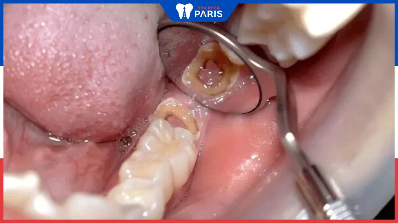 Bị viêm tủy răng bao lâu thì khỏi? Các yếu tố ảnh hưởng điều trị