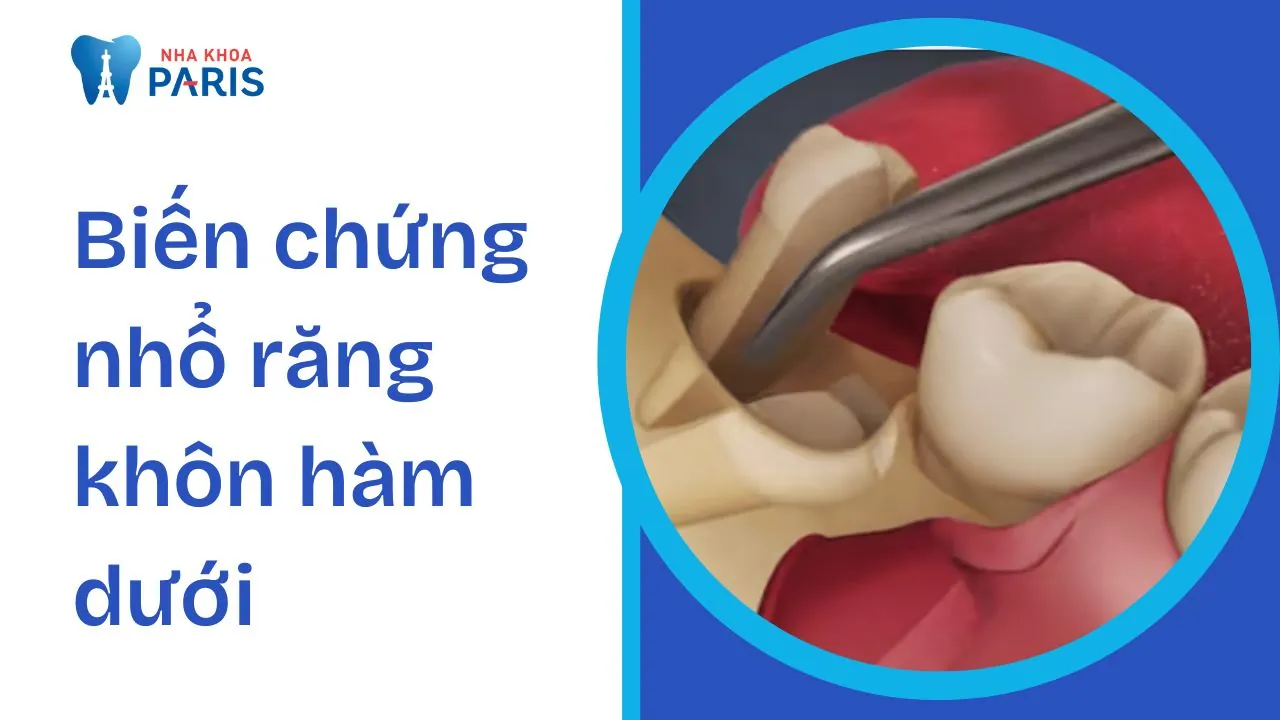 10+ biến chứng nhổ răng khôn hàm dưới và cách xử lý