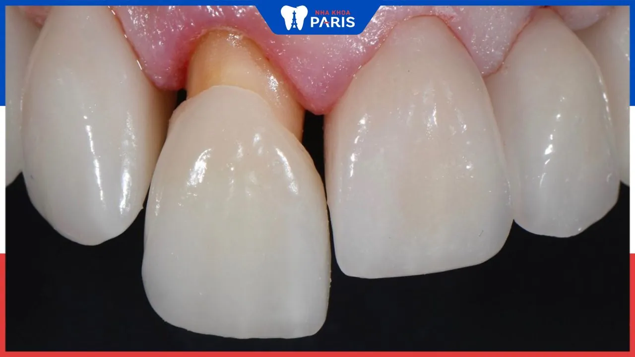 Giải đáp: Bọc răng sứ bị hở chân răng có nguy hiểm không