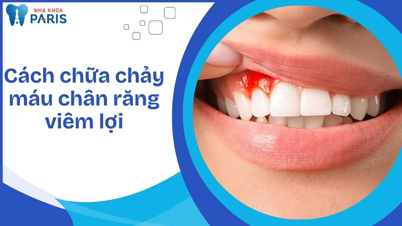 Cách chữa chảy máu chân răng viêm lợi và phòng ngừa hiệu quả