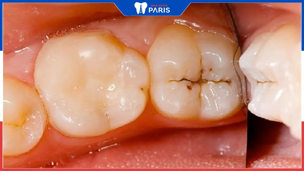 Tổng hợp 12 cách chữa sâu răng tại nhà an toàn và hiệu quả