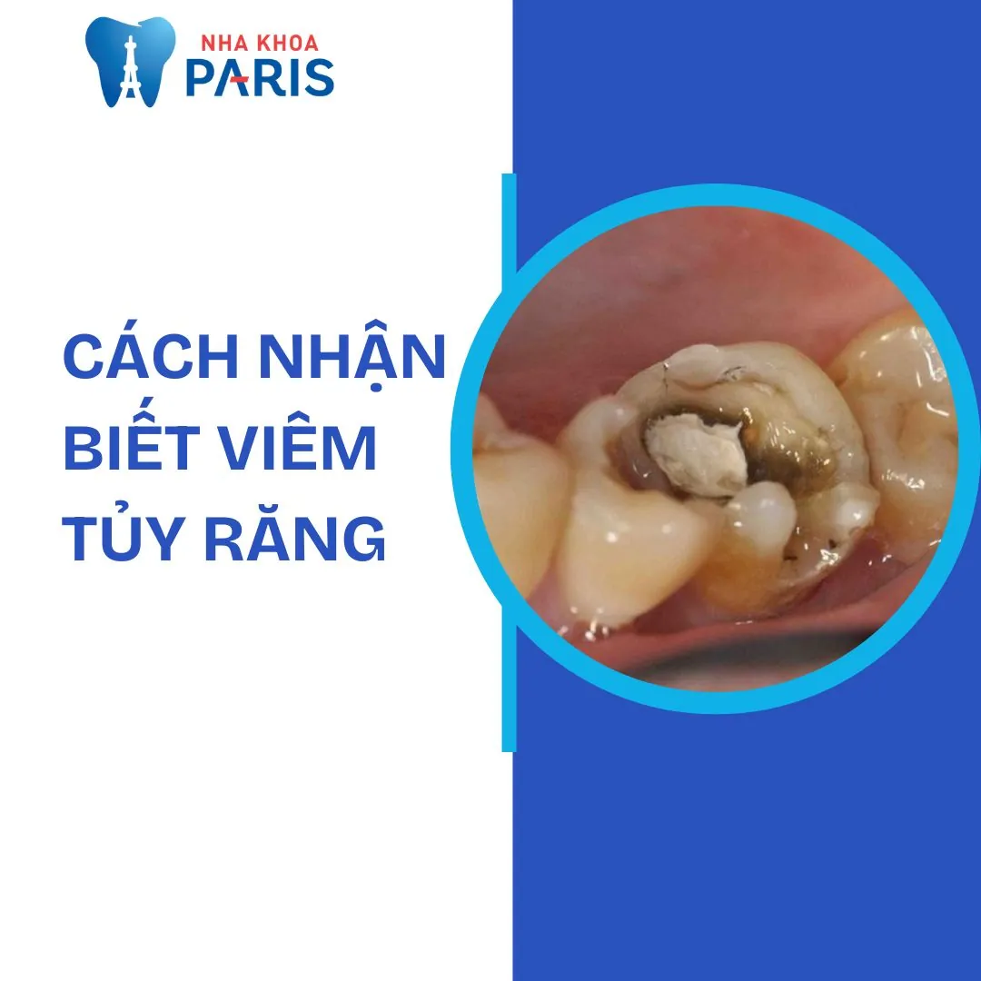 Cách nhận biết viêm tủy răng và giải pháp điều trị dứt điểm, an toàn