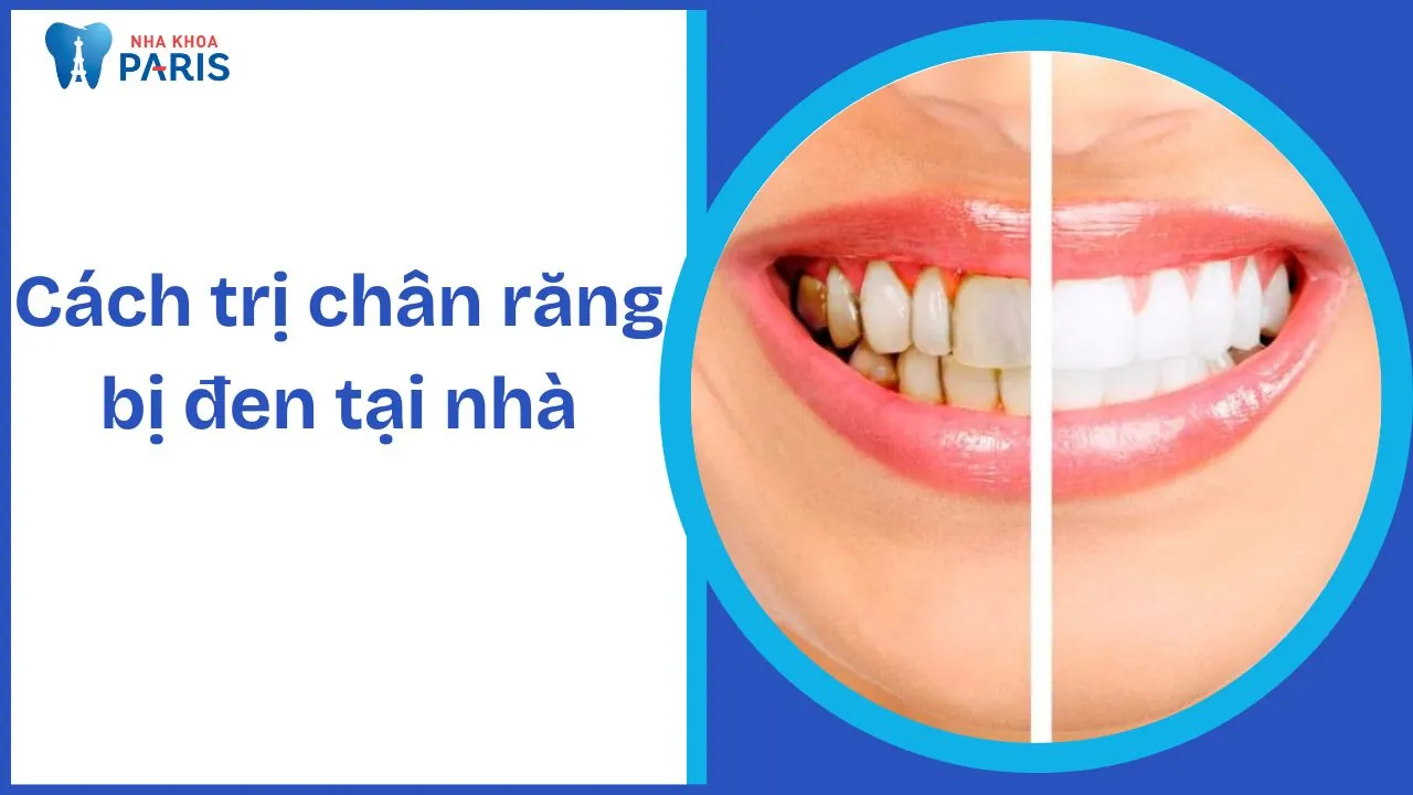 11 Cách trị chân răng bị đen tại nhà đơn giản hiệu quả tức thời