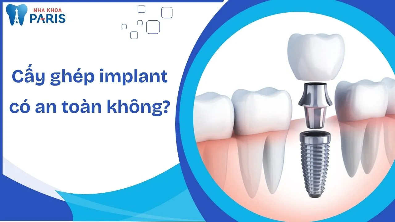 Cấy ghép implant có an toàn không? Bí quyết cắm implant hạn chế rủi ro