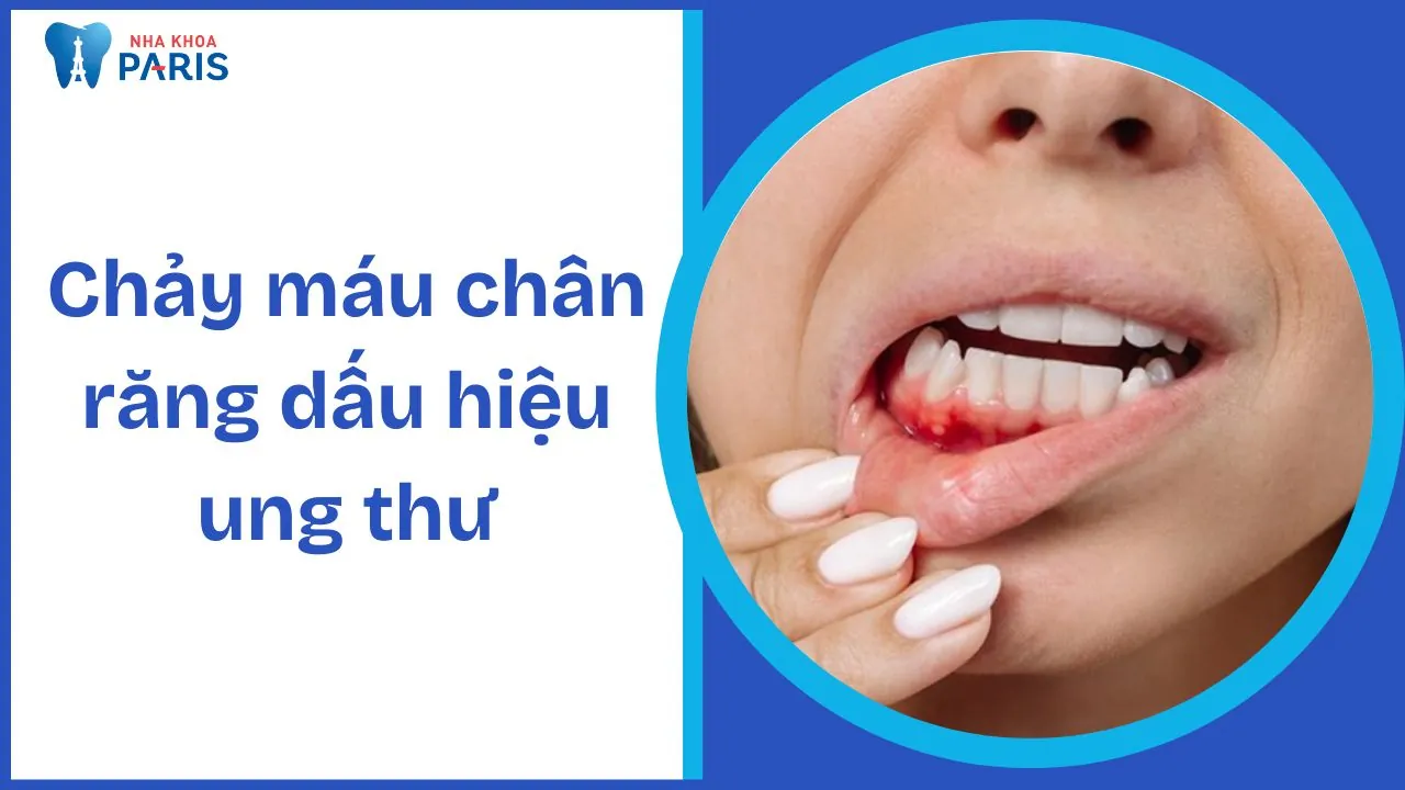 Chảy máu chân răng dấu hiệu ung thư nào và biện pháp xử lý hiệu quả