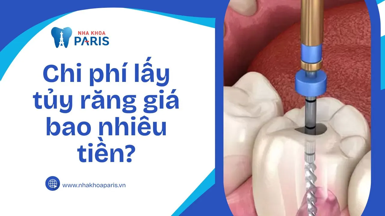 Chi Phí Lấy Tủy Răng Giá Bao Nhiêu Tiền? Quy Trình Và Bảng Giá Mới Nhất