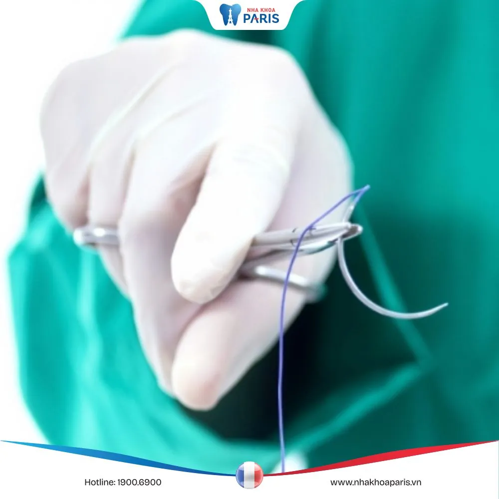 Chỉ tự tiêu khâu vết thương – những điều bạn cần biết