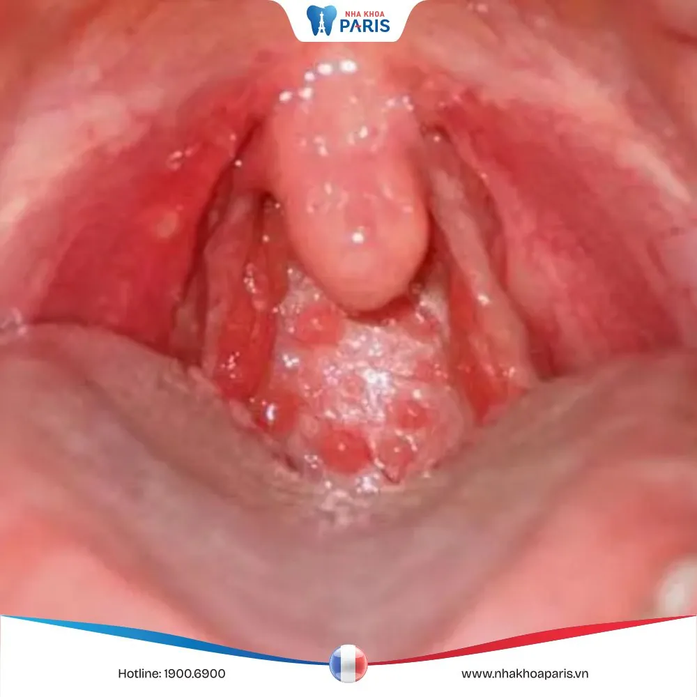 Tổng hợp cách chữa viêm họng hạt mãn tính tại nhà nhanh chóng
