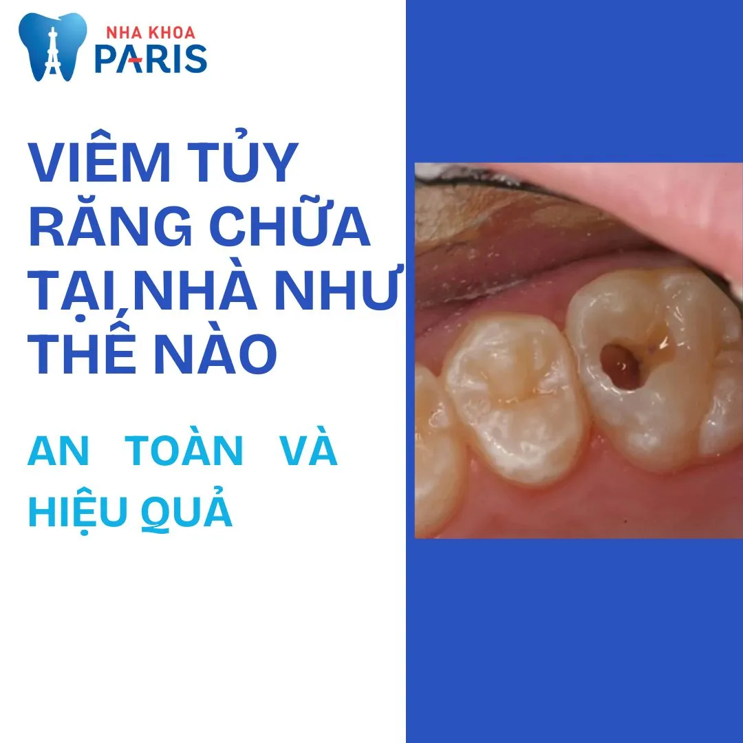 Viêm tủy răng chữa tại nhà như thế nào an toàn và hiệu quả