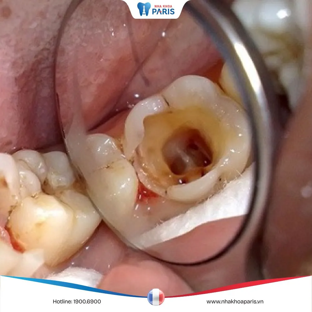 Có nên nhổ răng cấm bị sâu không? Những lưu ý trước khi nhổ