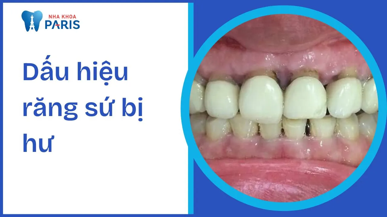 Dấu hiệu răng sứ bị hư và 3 cách khắc phục an toàn, hiệu quả