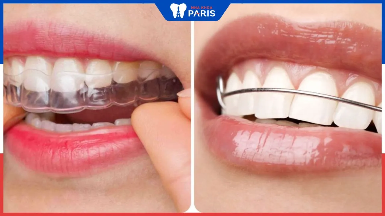 Đeo hàm duy trì trong bao lâu, các yếu tố ảnh hưởng
