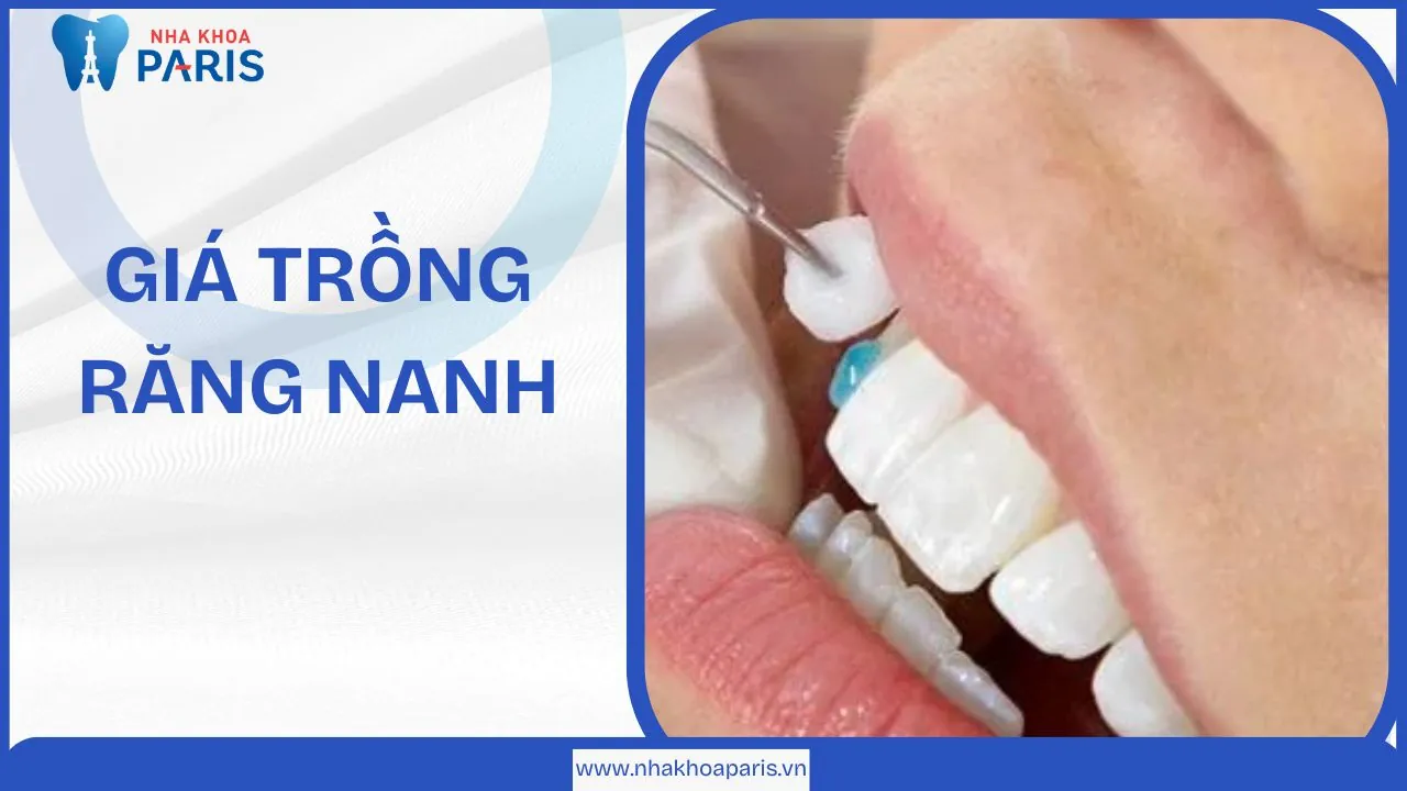 Giá trồng răng nanh mới nhất 2025 và các phương pháp hiện đại