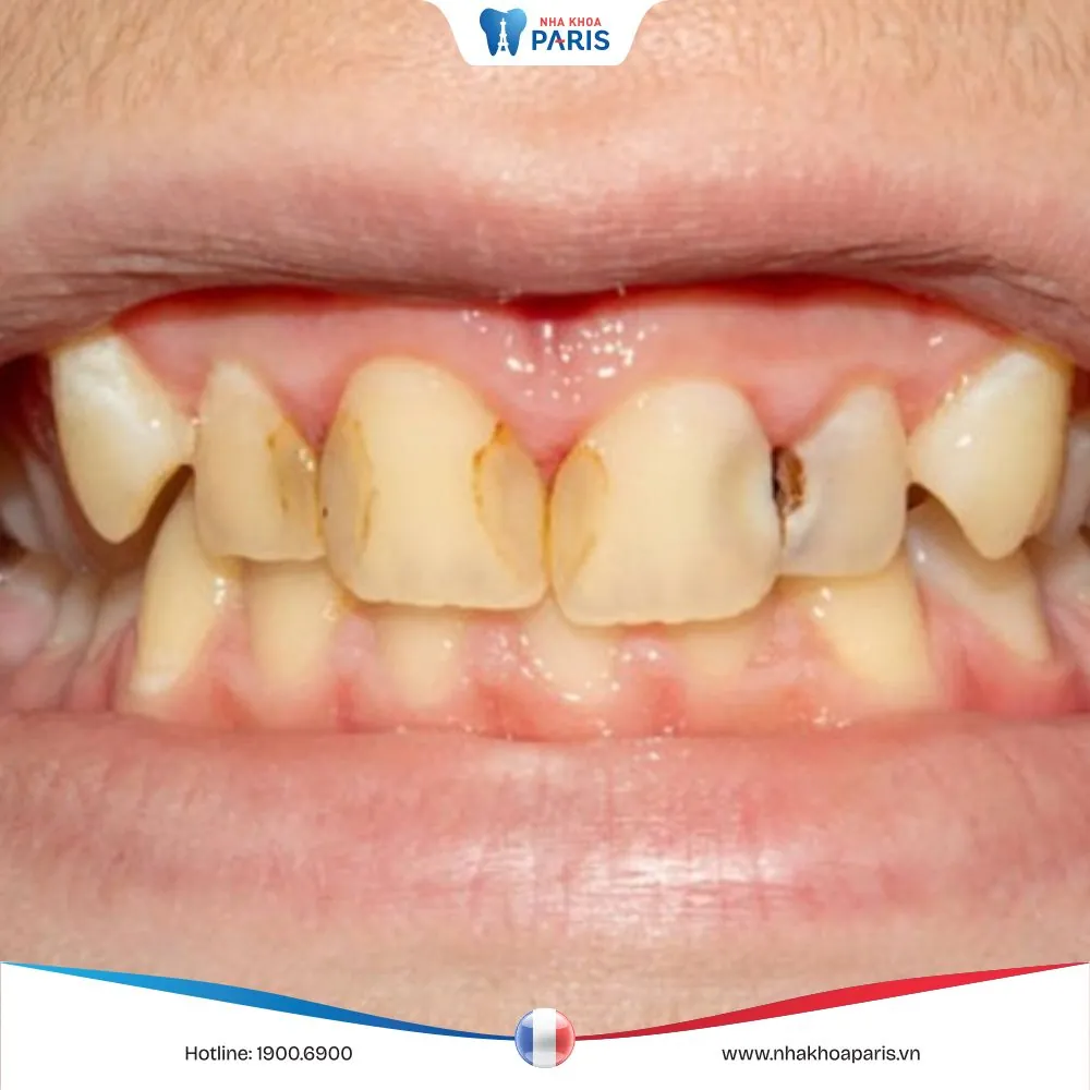 Thức ăn giắt vào kẽ răng do đâu? Cách vệ sinh hiệu quả