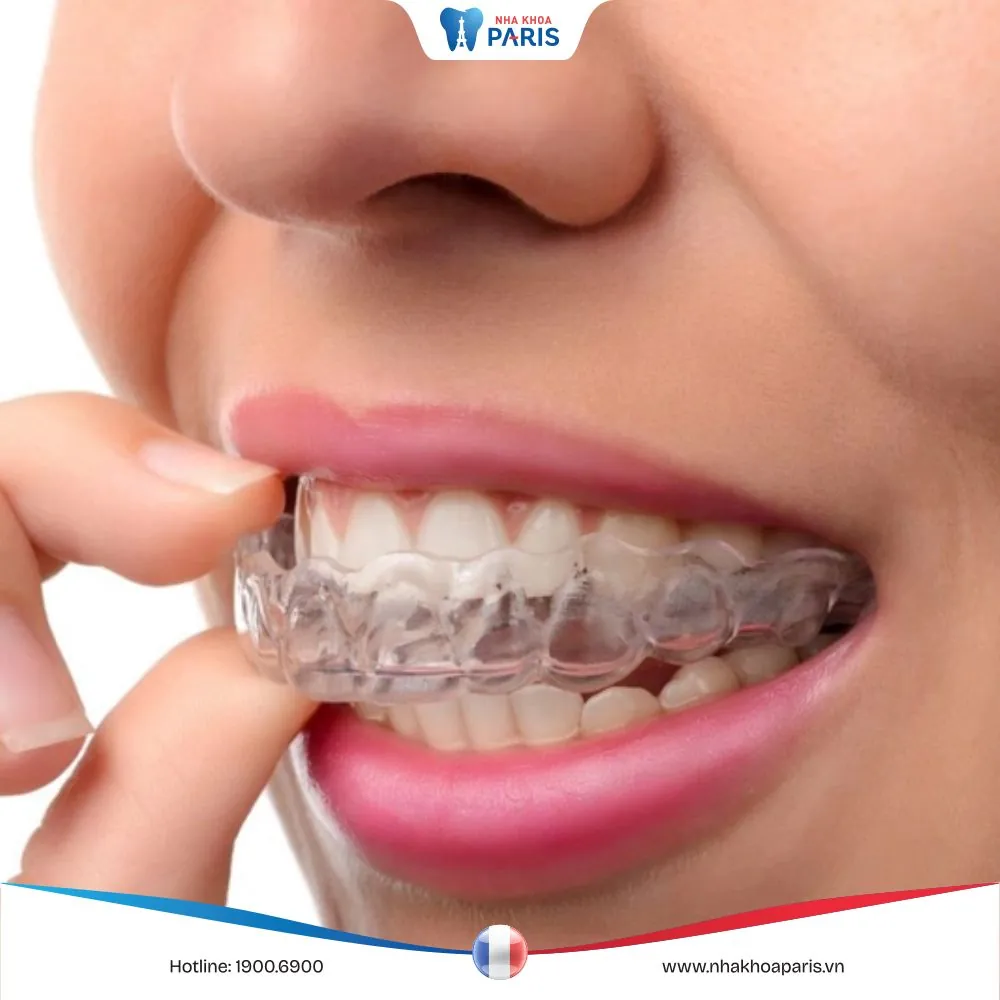 Đeo hàm duy trì sau khi niềng răng và những lưu ý quan trọng