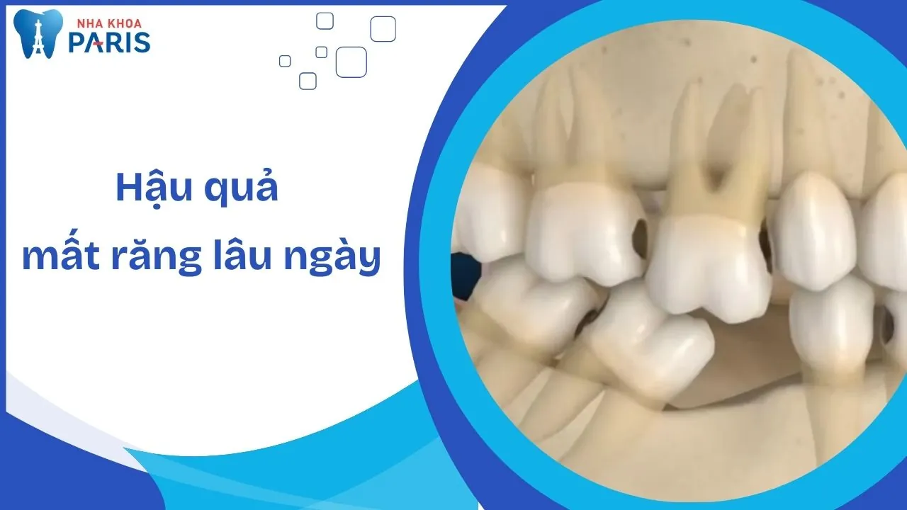 Hậu quả mất răng lâu ngày và cách khắc phục triệt để