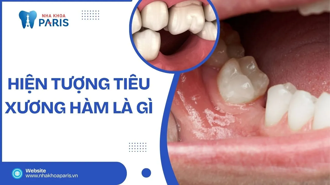 Hiện tượng tiêu xương hàm là gì? Hậu quả và cách khắc phục an toàn