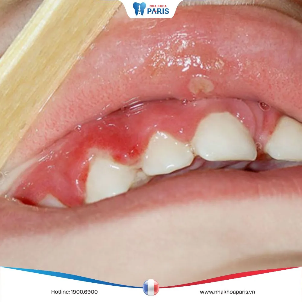 Hình ảnh viêm lợi ở trẻ em, nhận biết sớm và điều trị sớm