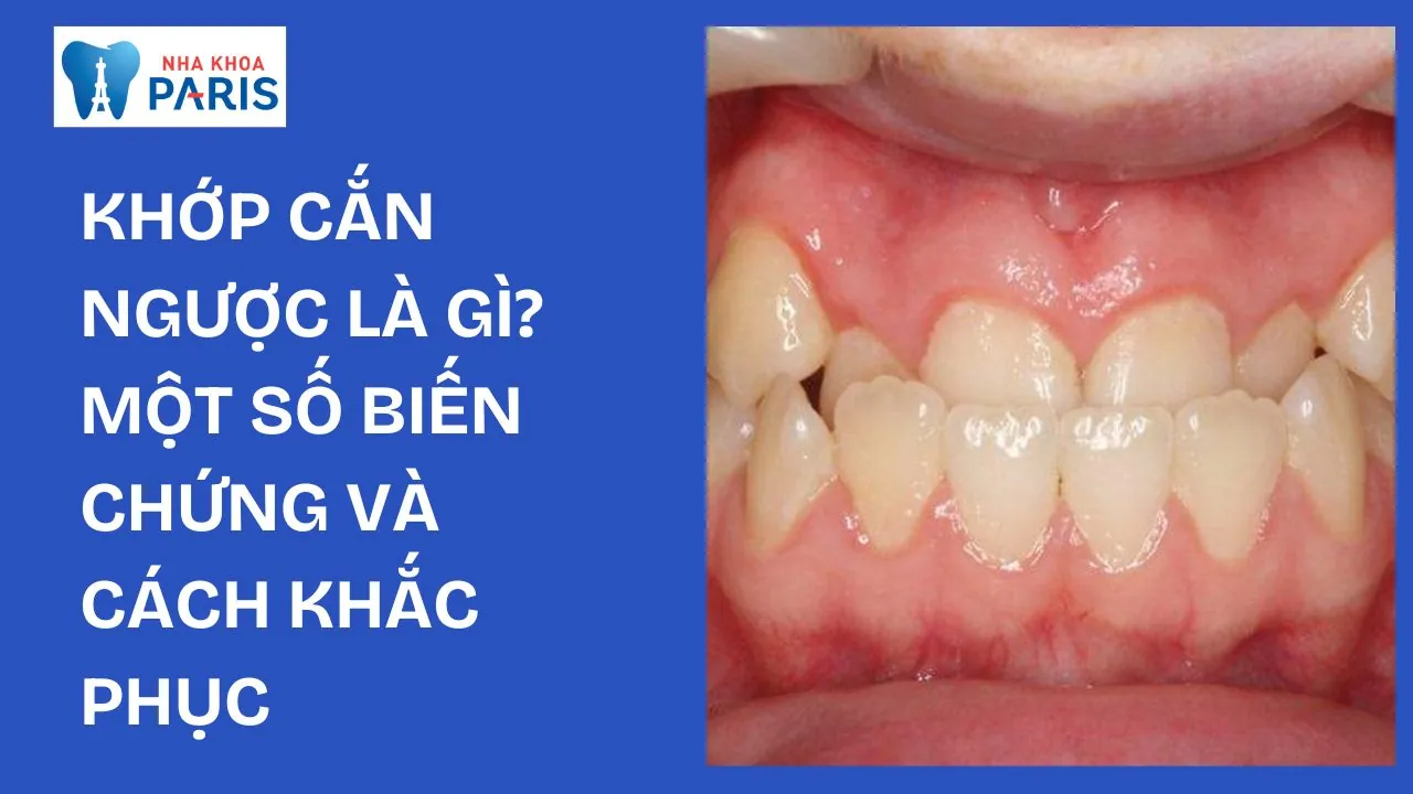 Khớp cắn ngược là gì? Nguyên nhân, biểu hiện và cách điều trị hiệu quả