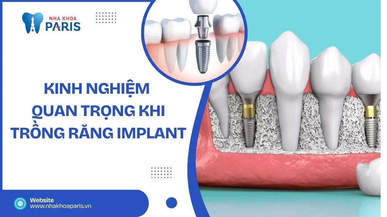 Kinh Nghiệm Trồng Răng Implant: Hướng Dẫn Từ A Đến Z Để Có Kết Quả Tốt Nhất