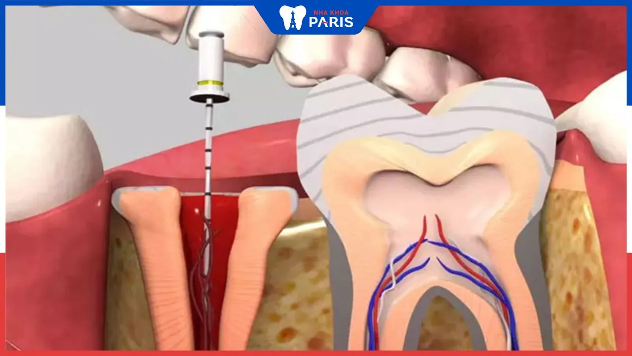 Làm chết tủy răng có đau không? Các yếu tố làm tủy răng bị chết