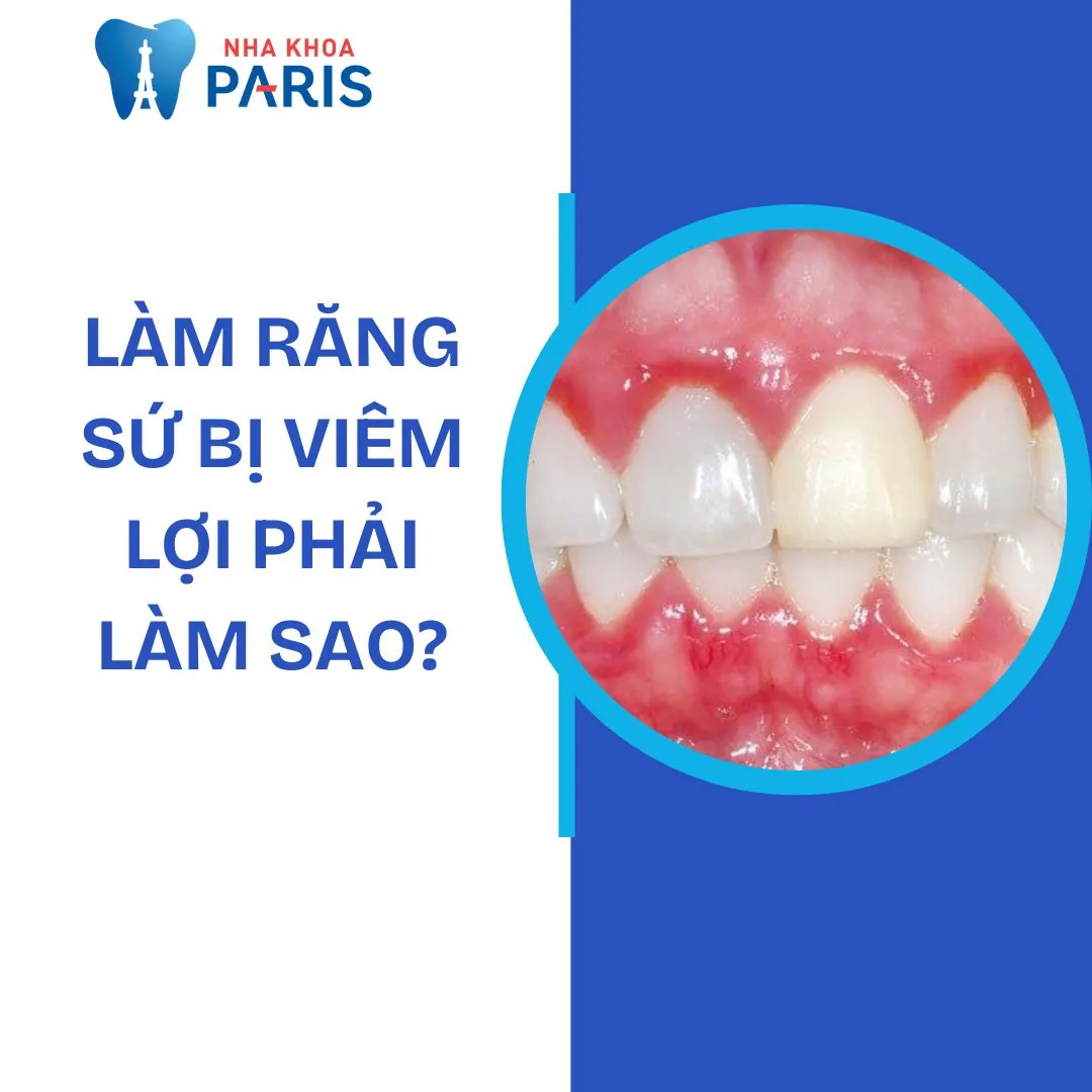 Làm răng sứ bị viêm lợi phải làm sao? Nguyên nhân và cách điều trị