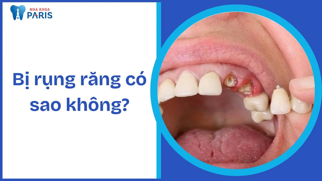 Bị rụng răng có sao không? Nguyên nhân, tác hại và cách khắc phục hiệu quả