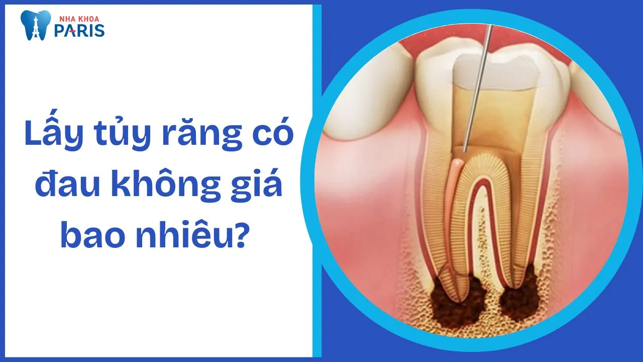 Lấy tủy răng có đau không giá bao nhiêu? Thông tin chi tiết