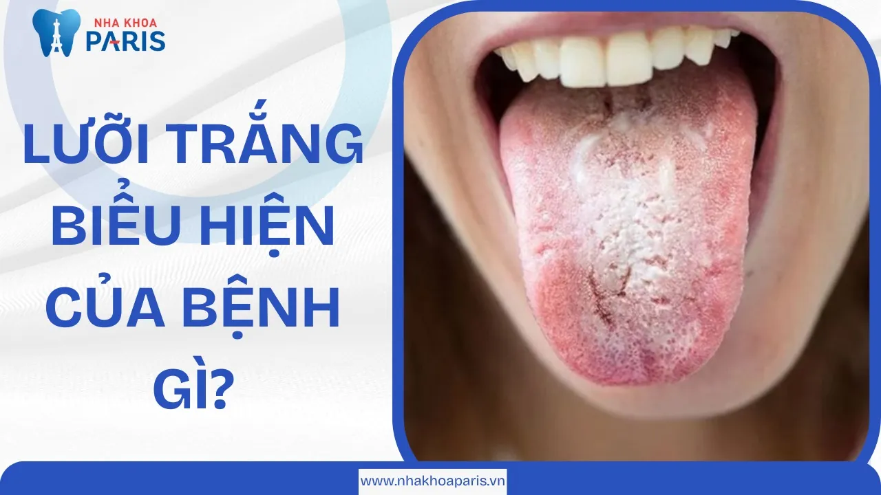 Lưỡi trắng biểu hiện của bệnh gì? Có nguy hiểm không?