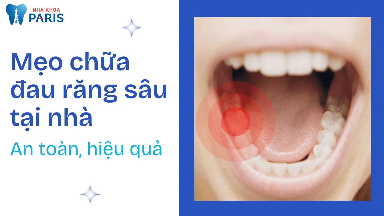 Bật mí 14 mẹo chữa đau răng sâu tại nhà an toàn, hiệu quả
