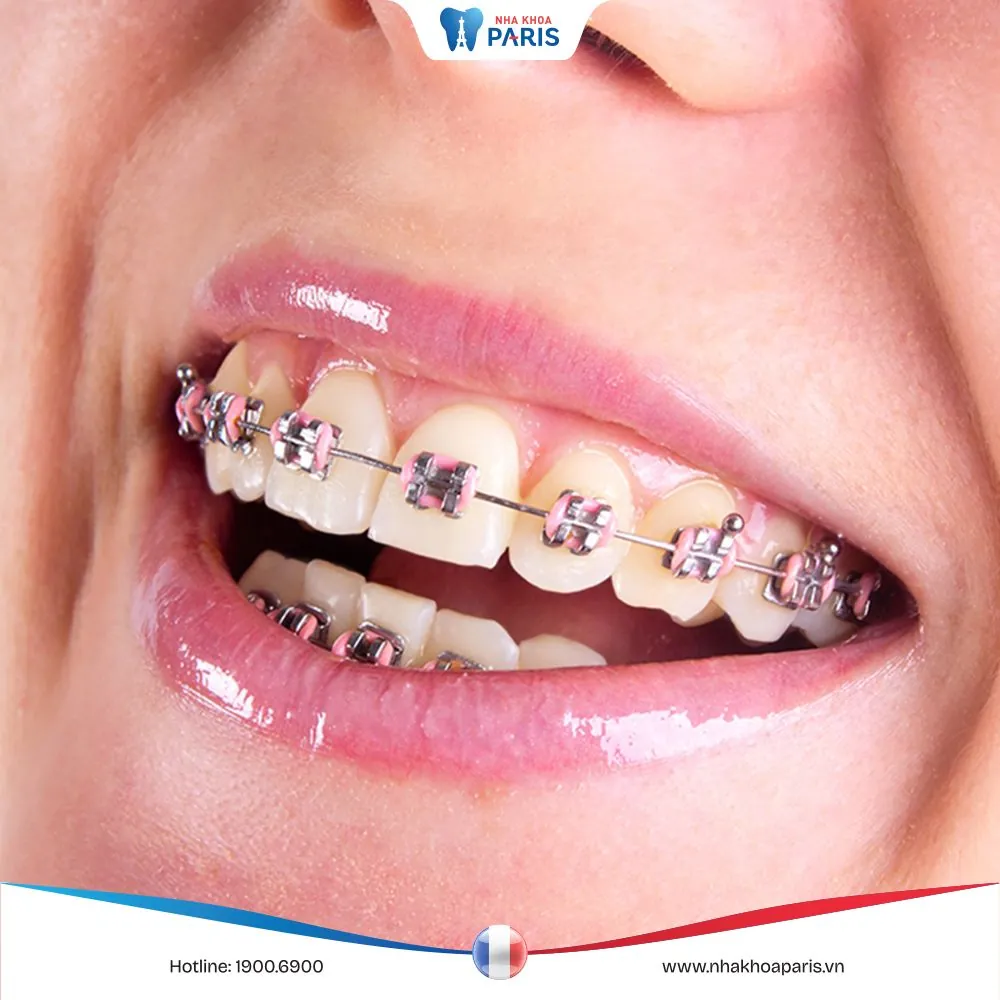 Nắn chỉnh răng là gì? Các phương pháp phổ biến kèm bảng giá