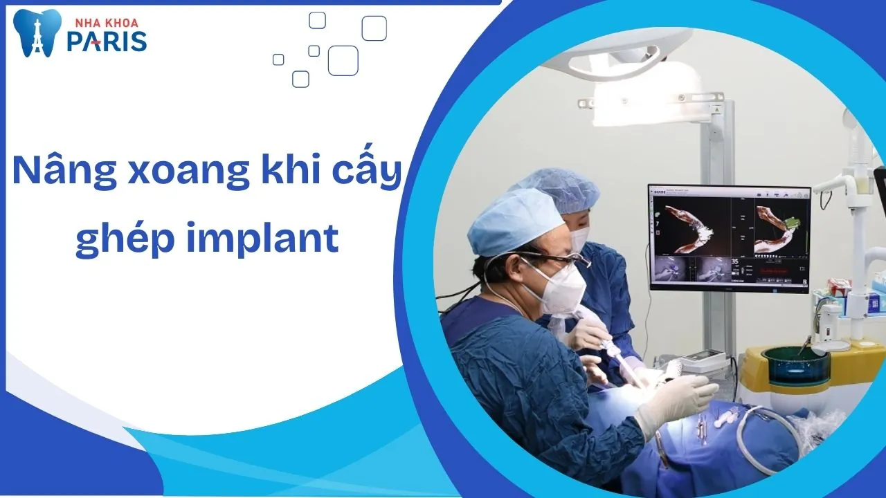 Giải mã từ A – Z thủ thuật nâng xoang khi cấy ghép implant