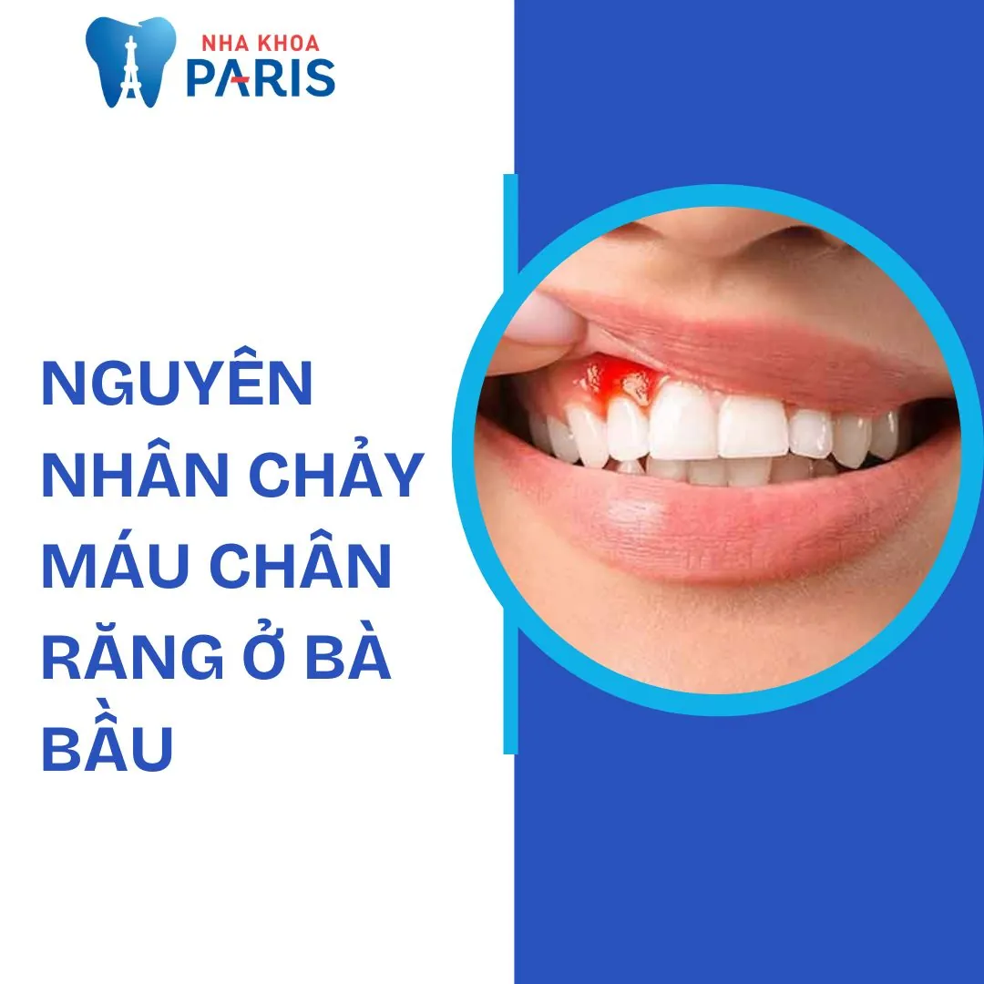 Nguyên nhân chảy máu chân răng ở bà bầu & Cách điều trị an toàn