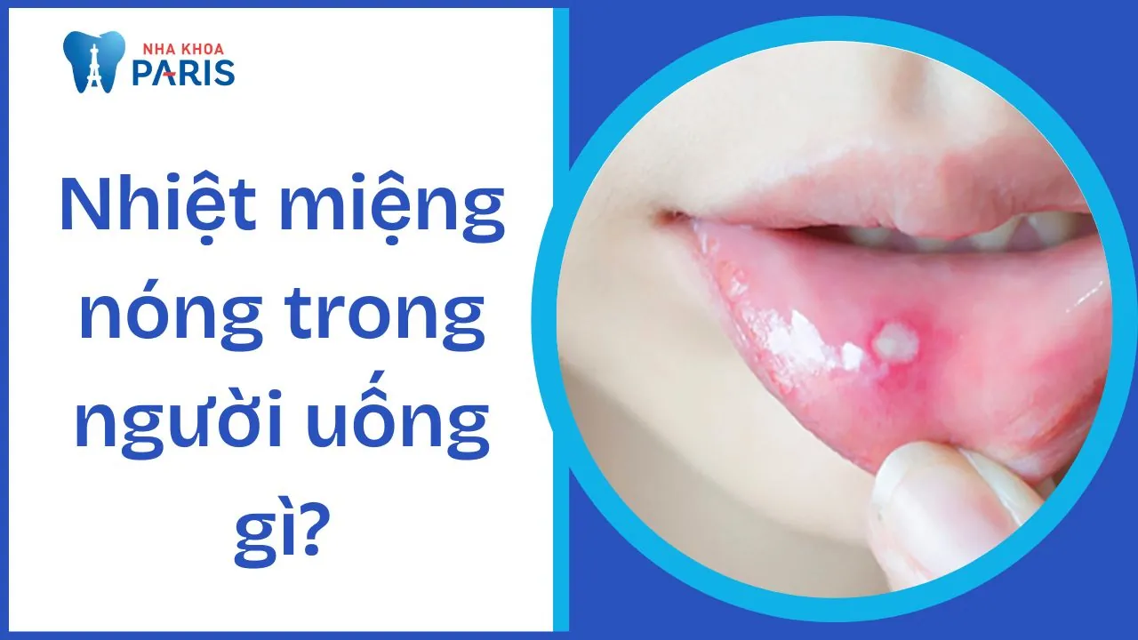Nhiệt miệng nóng trong người uống gì? Cách phòng ngừa nhiệt miệng