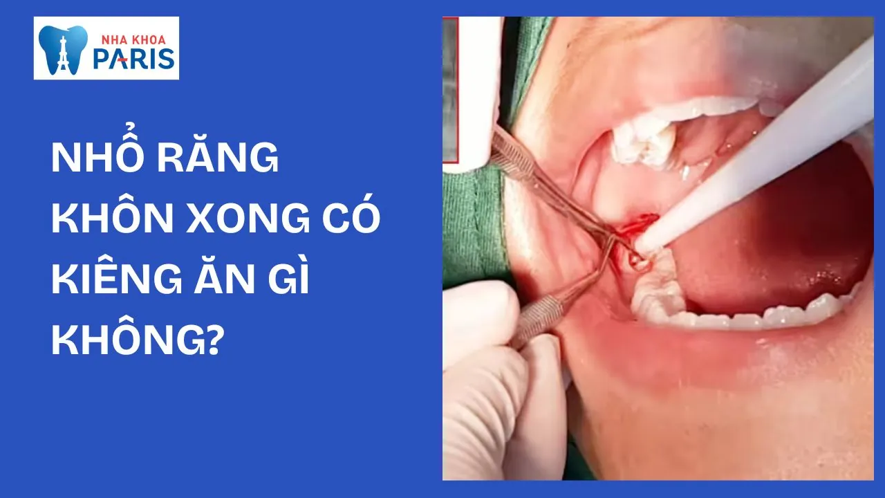 Nhổ răng khôn xong có kiêng ăn gì không? Nên ăn gì để mau lành?