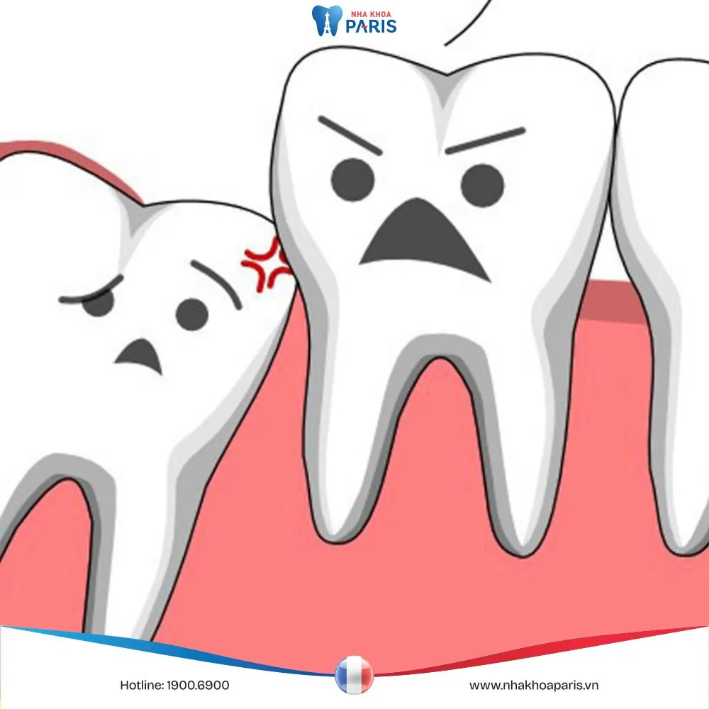 Nhổ răng khôn kiêng ăn gì để mau hồi phục, tránh biến chứng
