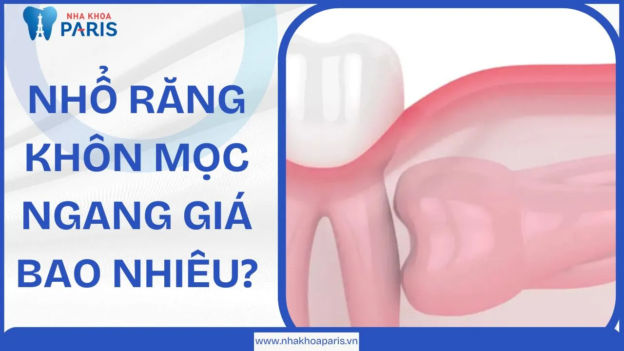 Nhổ răng khôn mọc ngang giá bao nhiêu và những điều bạn cần biết