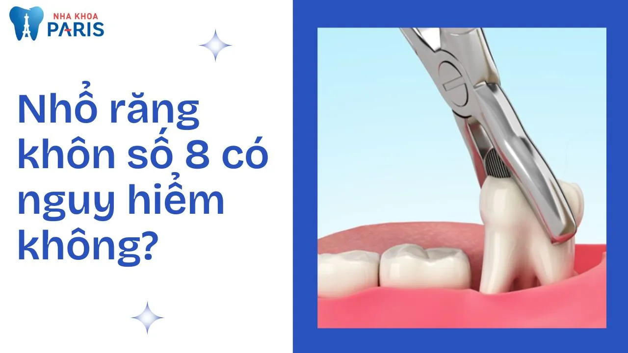 Nhổ răng số 8 có nguy hiểm không? Bác sĩ nha khoa giải đáp