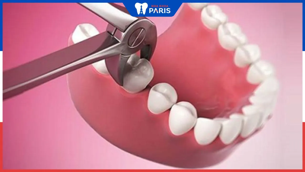 Nhổ răng số 5 có nguy hiểm không? một số yếu tố cần chú ý