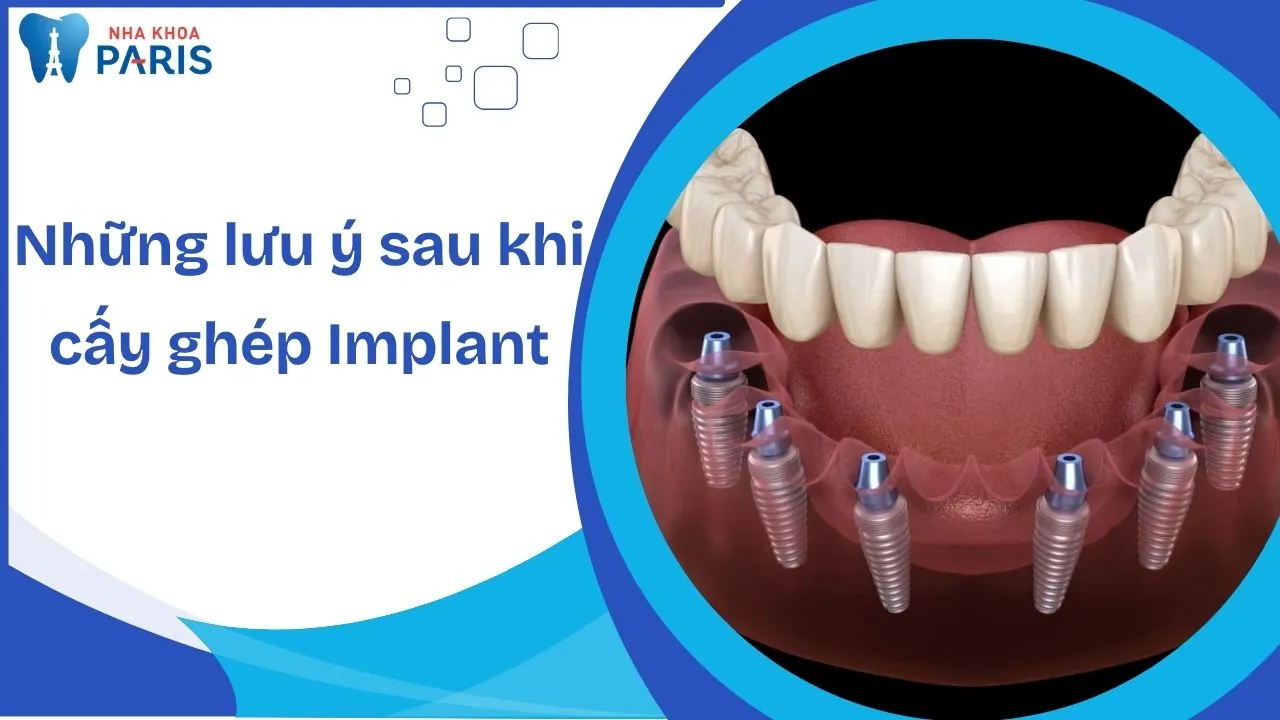 Những lưu ý sau khi cấy ghép Implant để đảm bảo hiệu quả cao
